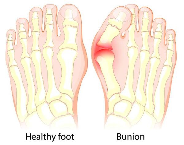 Bunions