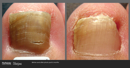 Fungal Toenail Treatment Before and After Photo