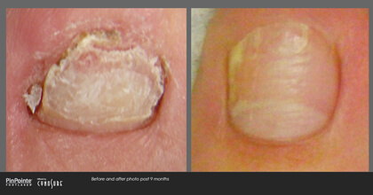 Fungal Toenail Treatment Before and After Photo