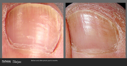 Fungal Toenail Treatment Before and After Photo