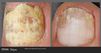 Fungal Toenail Treatment Before and After Photo