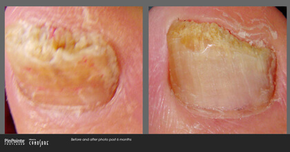 Fungal Toenail Treatment Before and After Photo