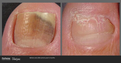 Fungal Toenail Treatment Before and After Photo