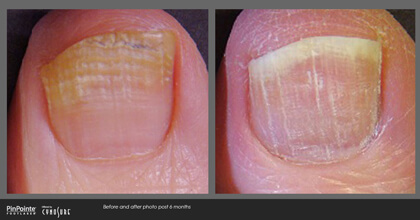 Fungal Toenail Treatment Before and After Photo