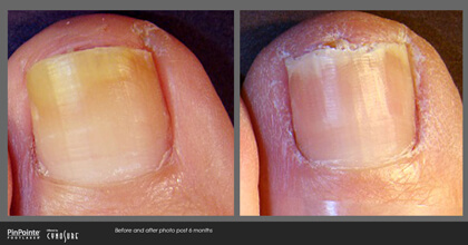 Fungal Toenail Treatment Before and After Photo