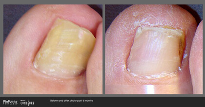 Fungal Toenail Treatment Before and After Photo