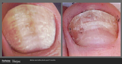 Fungal Toenail Treatment Before and After Photo