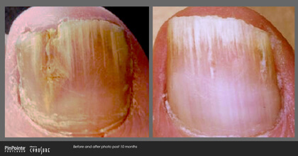 Fungal Toenail Treatment Before and After Photo