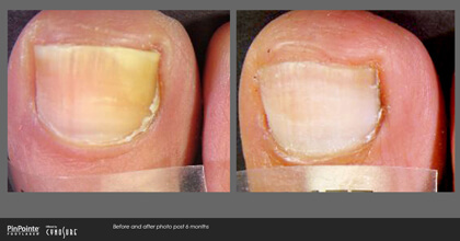 Fungal Toenail Treatment Before and After Photo