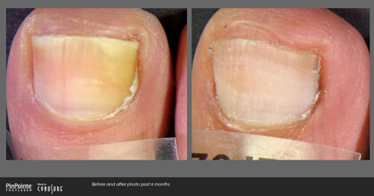 Fungal Toenail Treatment Before and After Photo