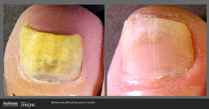 Fungal Toenail Treatment Before and After Photo