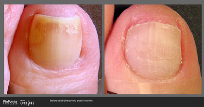 Fungal Toenail Treatment Before and After Photo