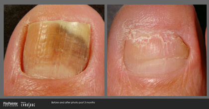 Fungal Toenail Treatment Before and After Photo