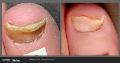 Fungal Toenail Treatment Before and After Photo