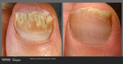 Fungal Toenail Treatment Before and After Photo