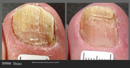 Fungal Toenail Treatment Before and After Photo