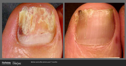 Fungal Toenail Treatment Before and After Photo