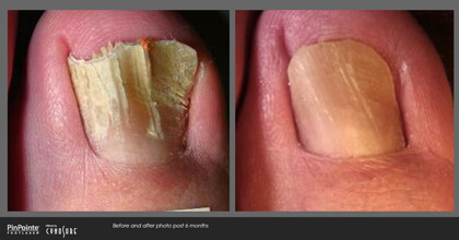 Fungal Toenail Treatment Before and After Photo