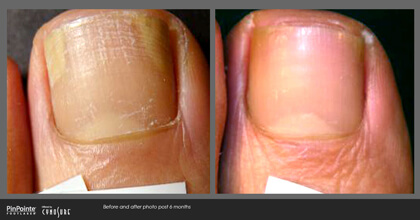 Fungal Toenail Treatment Before and After Photo