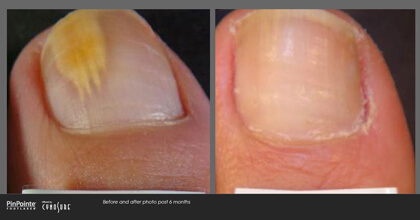 Fungal Toenail Treatment Before and After Photo