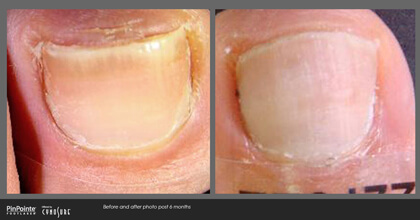 Fungal Toenail Treatment Before and After Photo