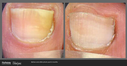 Fungal Toenail Treatment Before and After Photo