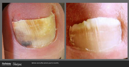 Fungal Toenail Treatment Before and After Photo