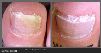 Fungal Toenail Treatment Before and After Photo