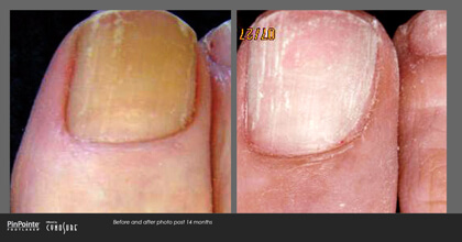 Fungal Toenail Treatment Before and After Photo