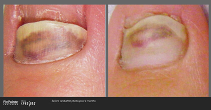 Fungal Toenail Treatment Before and After Photo