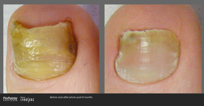 Fungal Toenail Treatment Before and After Photo