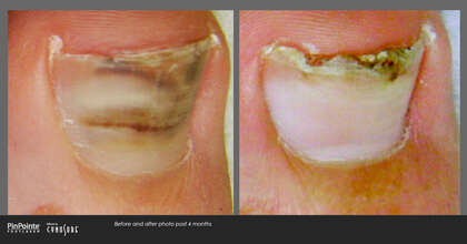 Fungal Toenail Treatment Before and After Photo