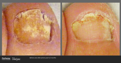 Fungal Toenail Treatment Before and After Photo