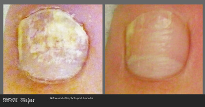 Fungal Toenail Treatment Before and After Photo